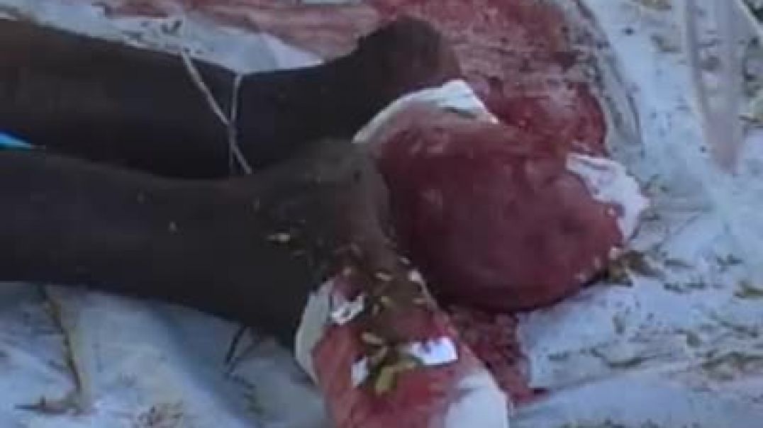 injured leg of a tamil civilian| இனப்படுகொலை | Tamil genocide | mullivaikkal | முள்ளிவாய்க்கால்